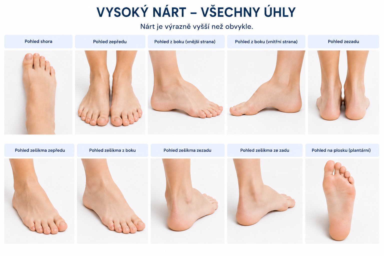 Vysoký nárt u dítěte – fotografie chodidla z různých úhlů